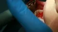 Procedure of teeth polishing HD Footage