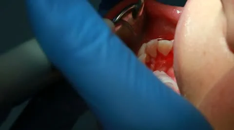 Procedure of teeth polishing Stock Footage 10767311