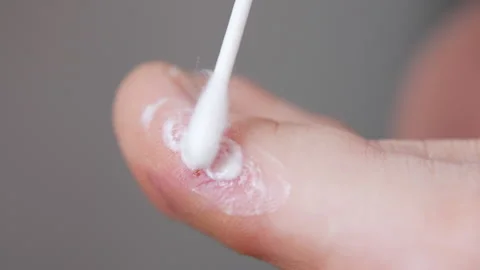 Process of applying medicinal ointment on acute dyshidrotic eczema on human toe Stock Footage 325622603