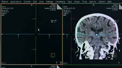 Process of brain scanning, close up. Video stock 92015959
