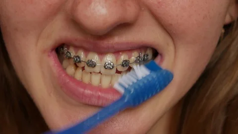 Process of brushing teeth with brackets closeup. Girl with braces brushes teeth Stock Footage 119085942