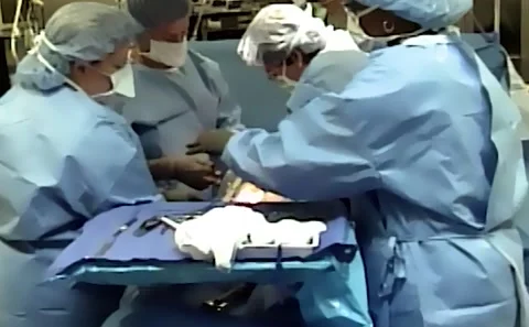 Process of a c section baby being removed while the mother is under Extremely Stock Footage 163853610