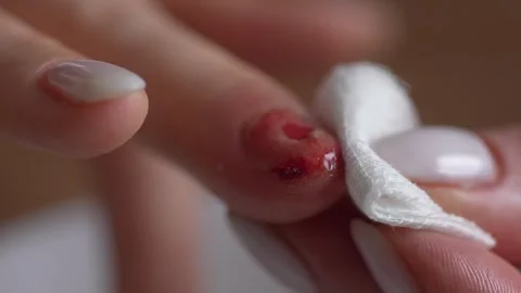 Process of Care a Finger with a Nail Wound. Stock Footage 261805030
