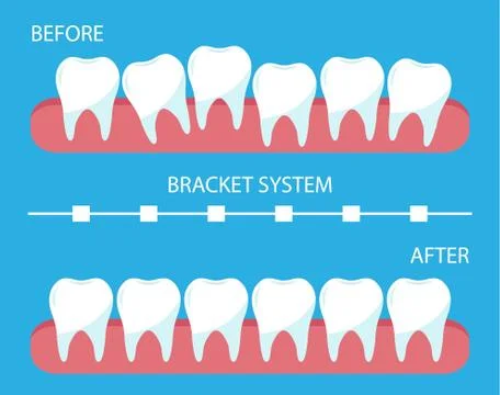The process of correction of teeth with orthopedic braces. Illustrazione stock