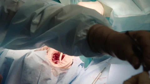 The process of dental surgery. Stock Footage 236053290
