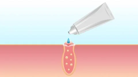The process of eliminating acne, cleaning pores, skin treatment, exposure to gel Stock Illustration