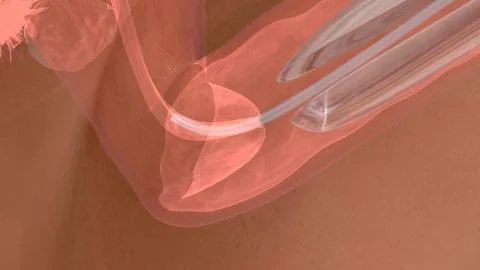 Process of embryo transfer Stock Illustration