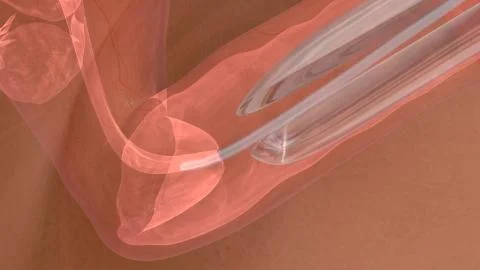 Process of embryo transfer Stock Illustration