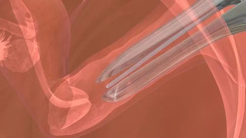 Process of embryo transfer Stock Illustration
