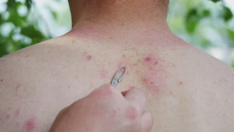 The process of extracting bee sting from the human body. Bee stings for health Stock Footage 245943600