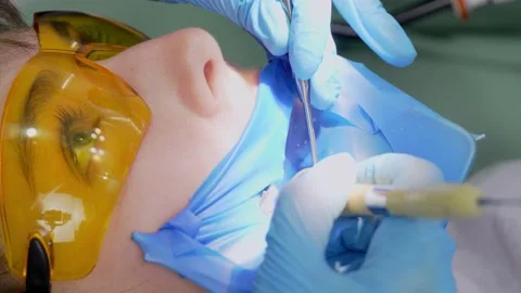 Process of filling patient's diseased tooth using modern equipment 库存影片 237691755