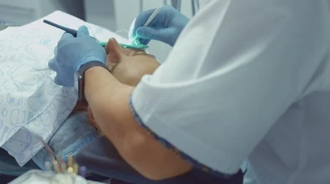 Process of filling the sick tooth of the patient using modern dental equipment Stock Footage 68080536