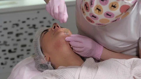 The process of inserting needles into the skin of the face to correct the oval.. Stock Footage 125799025