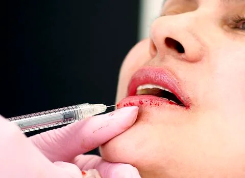 The process of lips enhancement. Doctor's hand injects botox into a woman's l 스톡 사진