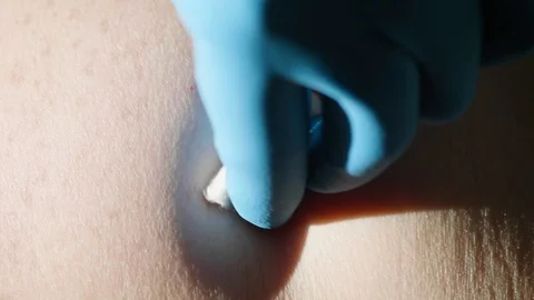 Process of making injection rapidly and bruse left after [previous injections Stock Footage 114123225