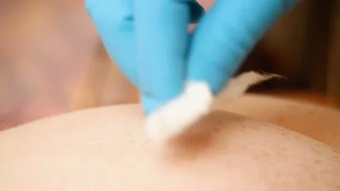 Process of making injection, view of bruses after previous injections. Cotton on Stock Footage 114133068