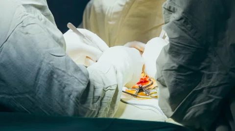 Process of operation Stock Footage 53216527