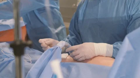 The process of performing an operation by a group of professional doctors. Stock Footage 245018829