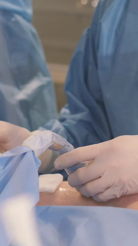 The process of performing an operation by a group of professional doctors Stock Footage 252129045