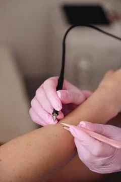 The process of permanent hair removal, using an electroepilation device Stock Photos