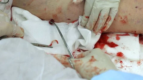 Process of removing the affected part of the vein in varicose veins Stock Footage 227553498