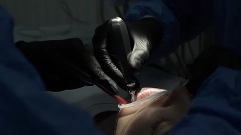 Process of removing a complex tooth in dentistry Stock Footage 256835962
