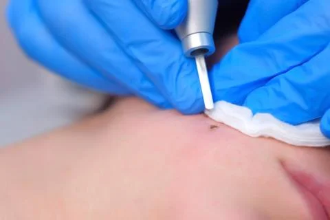 Process of removing mole using laser on woman's face by surgeon, burning skin. Stock Photos