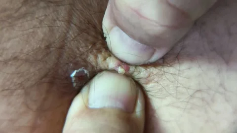 The process of removing pus by squeezing with both thumbs. Two small, red, .. Stock Footage 338438713