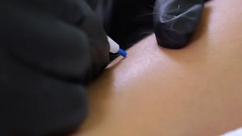 The process of removing unwanted hair using an electroepilation device. Stock Footage 322215763