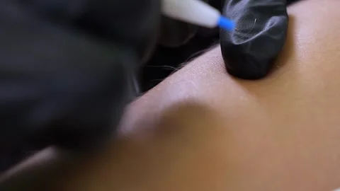 The process of removing unwanted hair using an electroepilation device. Stock Footage 323912027