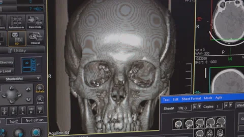 The process of Scanning the human skull displayed On the Monitor Stock Footage 107489139