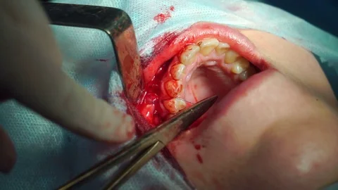 Process of sewing gums in the clinic. Oral and Maxillofacial Surgery. Stock Footage 74919448