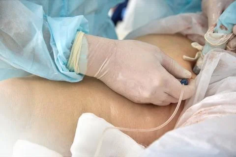 Process surgeon's work on operation to remove varicose veins in a modern way Stock Photos