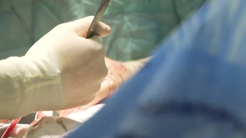The process of surgery and the hands of doctors Video stock 164723161
