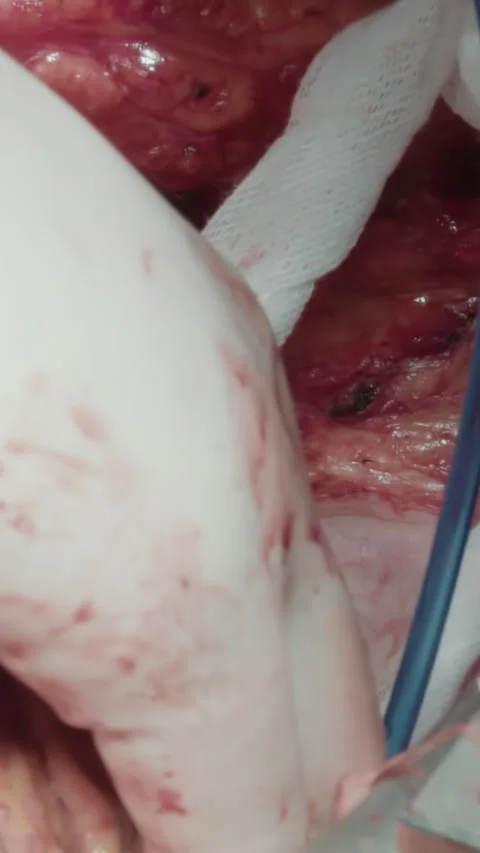 Process of surgery in cardiology Stock Footage 316506607