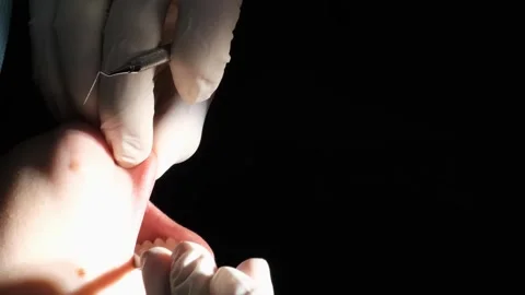 The process of treating the patient's teeth with a crown torch. Vertical video Stock-Footage 250128341