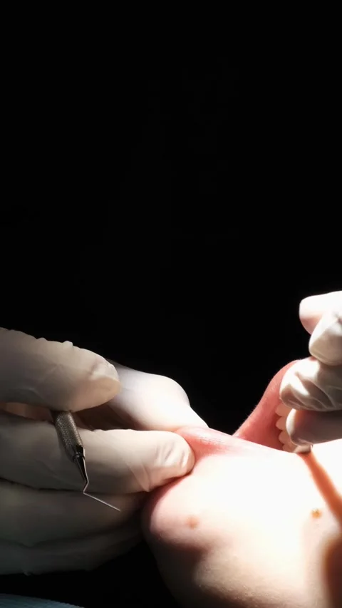 The process of treating the patient's teeth with a crown torch. Vertical video Vídeos de archivo 250383705