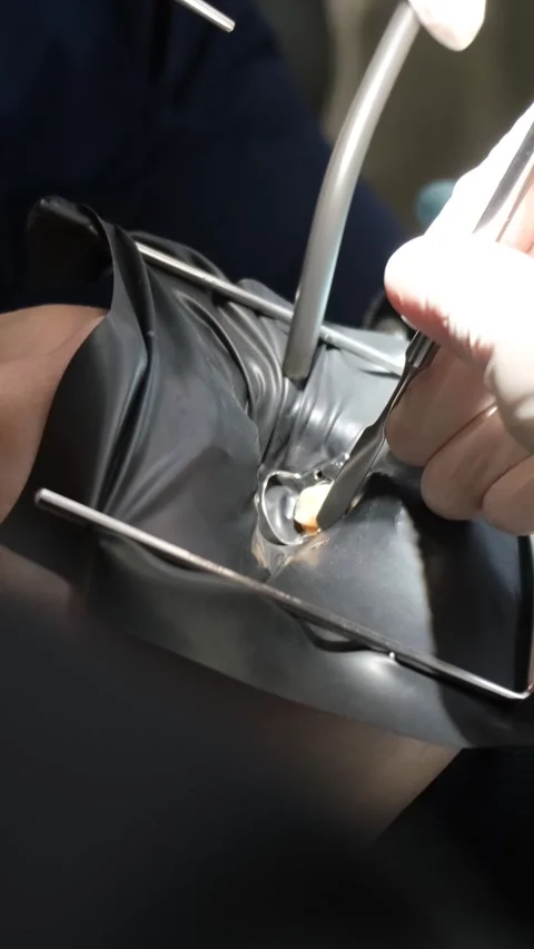 The process of treating the teeth of a young woman using modern technologies and Video stock 250383893
