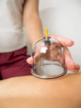 Process of vacuum cupping massage Stock Photos