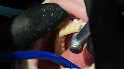 Process of veneers installing. Veneers setting in modern dentistry. Close-up Stock Footage 150213245