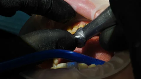 Process of veneers installing. Veneers setting in modern dentistry. Close-up Stock Footage 150214482