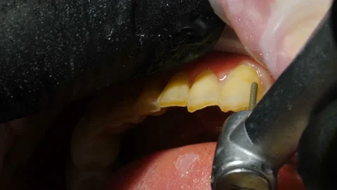 Process of veneers installing. Veneers setting in modern dentistry. Close-up Stock Footage 150215021