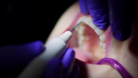 Professional dentist cleaning the upper teeth of a woman patient from plaque Stock Footage 256988118