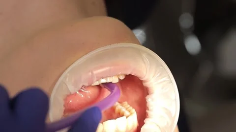 A professional dentist performs a teeth whitening procedure. Beautiful smile Stock Footage 250131150
