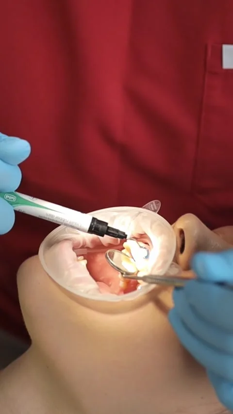 A professional dentist performs a teeth whitening procedure. Beautiful smile Stock-Footage 250383504
