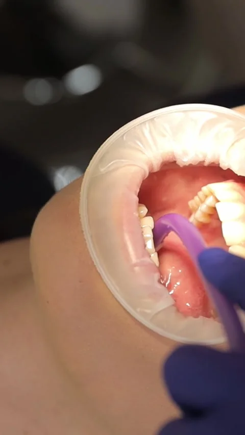 A professional dentist performs a teeth whitening procedure. Beautiful smile Stock Footage 250384187