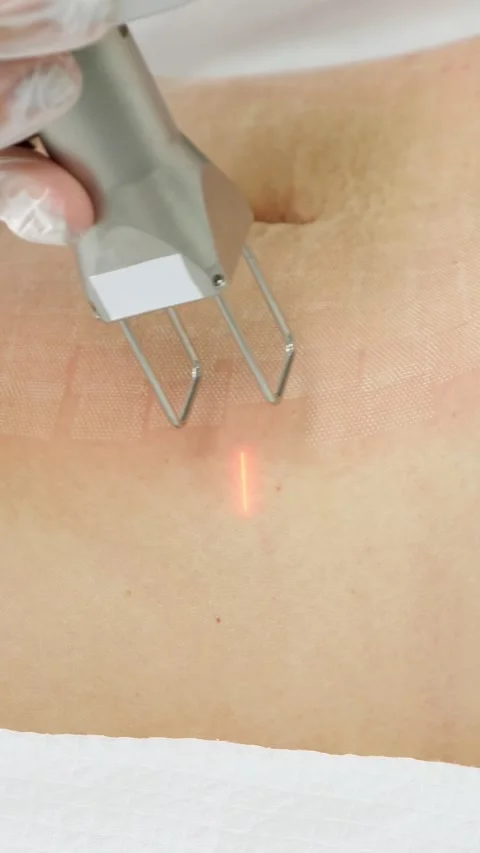 Professional dermatologist using a fractional co2 laser for skin resurfacing Stock Footage 340840549