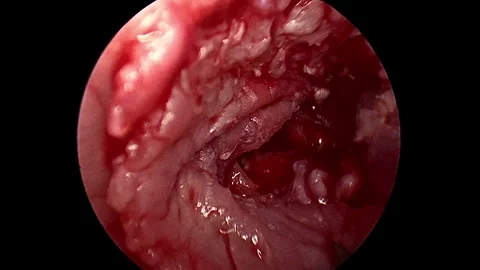 Professional endoscopic otologic surgery recorded in a clinical setting. Stock Footage 335308101
