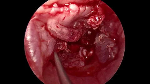Professional endoscopic otologic surgery recorded in a clinical setting... Видео 344742353