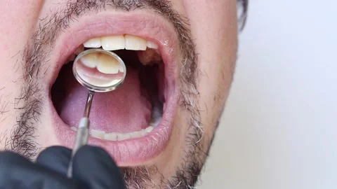 Professional examination of the condition of teeth using a dental mirror Stock Footage 346703375